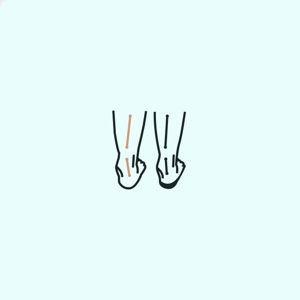 Overpronation